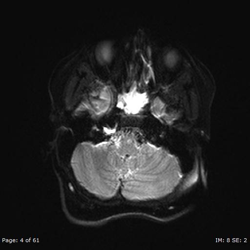 File:Balo concentric sclerosis (Radiopaedia 61637-69636 Axial DWI 4).jpg