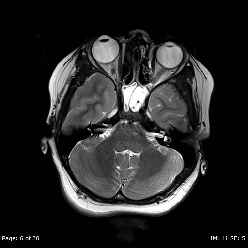 File:Balo concentric sclerosis (Radiopaedia 61637-69636 Axial T2 6).jpg
