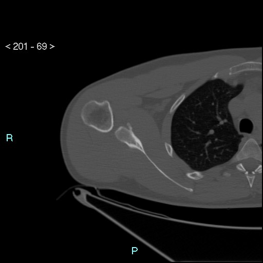 Bankart lesion with glenoid bone defect - assessment TC with PICO method (Radiopaedia 42855-93901 Axial bone window 68).jpg