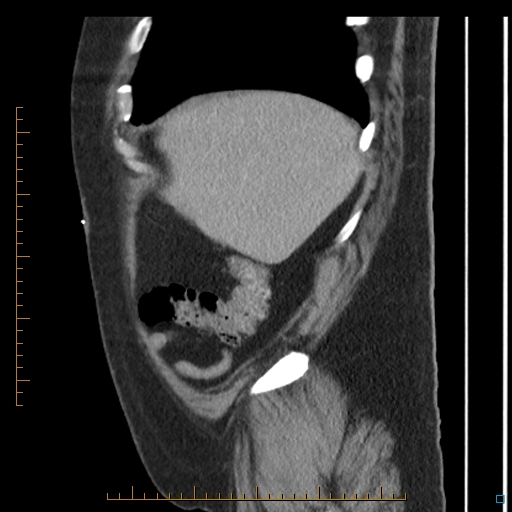 File:Bariatric balloon causing gastric outlet obstruction (Radiopaedia 54449-60672 C 70).jpg