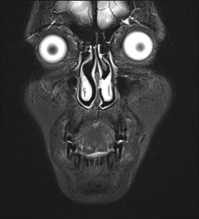 File:Basal cell carcinoma - nasal region (Radiopaedia 70292-80365 Coronal STIR 9).jpg