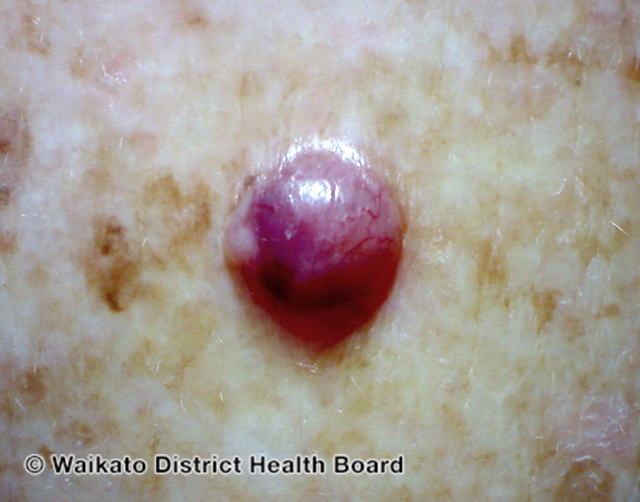 File:Basal cell carcinoma affecting the arms and legs 4 macro (DermNet NZ bcc-4-macro).jpg