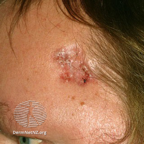 Basal cell carcinoma affecting the face (DermNet NZ lesions-bcc-face-0627).jpg