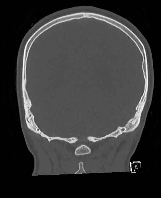 Base of skull fracture with bilateral Le Fort fractures (Radiopaedia 47094-51638 Coronal bone window 27).jpg