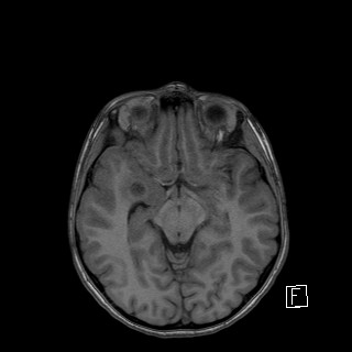 Base of skull rhabdomyosarcoma (Radiopaedia 32196-33142 Axial T1 22).jpg