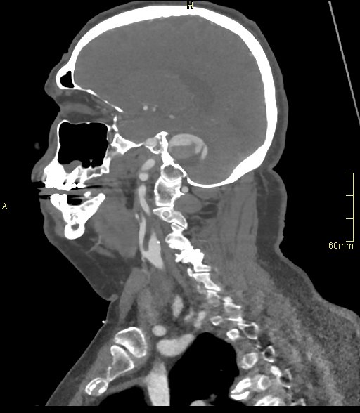 Basilar artery aneurysm (Radiopaedia 56261-62932 C 14).jpg