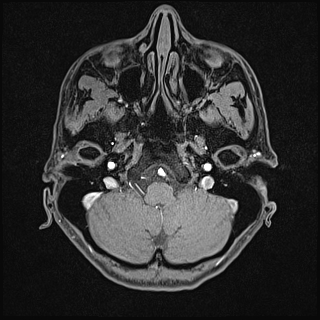 File:Basilar artery perforator aneurysm (Radiopaedia 82455-97733 Axial T1 fat sat 23).jpg