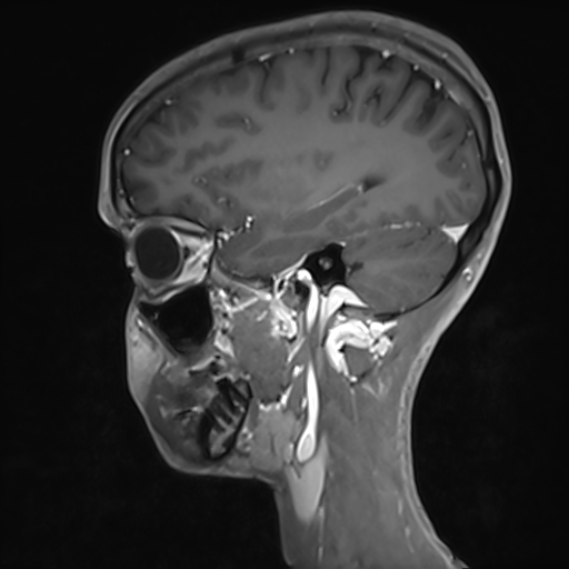 Basilar artery perforator aneurysm (Radiopaedia 82455-97733 G 47).jpg