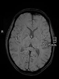 Basilar artery perforator aneurysm (Radiopaedia 82455-99523 Axial SWI 35).jpg