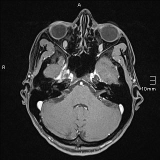Basilar artery perforator aneurysm (Radiopaedia 82455-99523 G 28).jpg