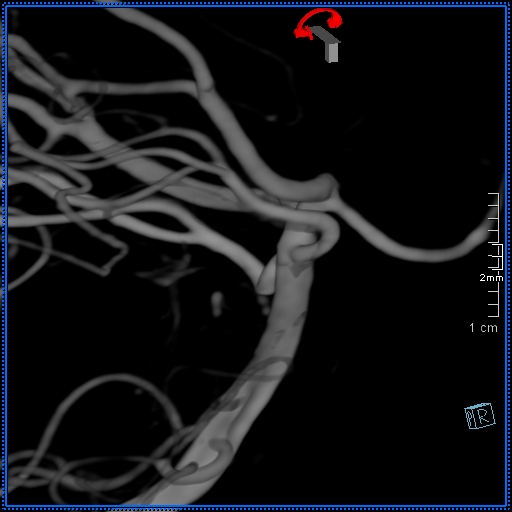 Basilar artery perforator aneurysm (Radiopaedia 82455-99524 3D Left VA 70).jpg