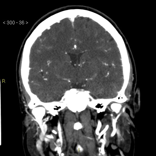 Basilar artery thrombosis (Radiopaedia 16260-15944 B 27).jpg