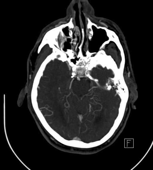 Basilar artery thrombosis (Radiopaedia 26986-27163 A 34).jpg