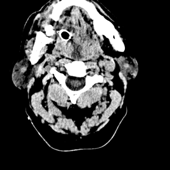 Basilar artery thrombosis (Radiopaedia 53351-59333 Axial non-contrast 2).jpg