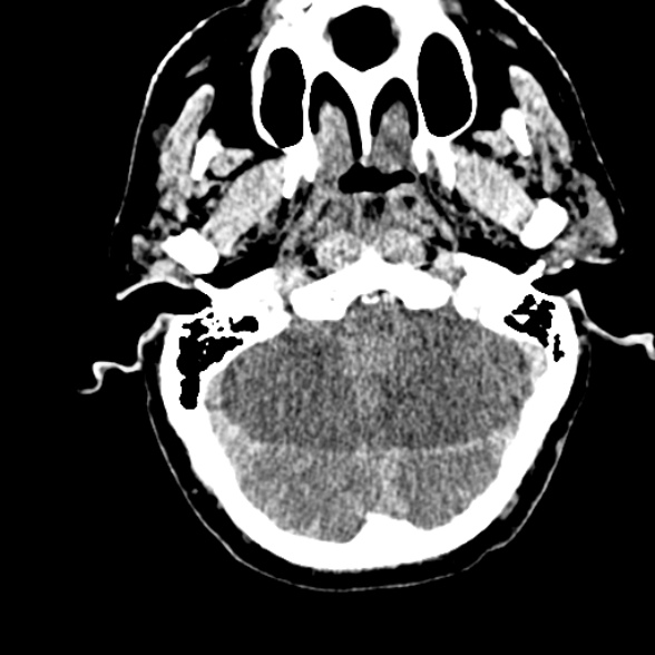 Basilar artery thrombosis (Radiopaedia 53351-59352 Axial non-contrast 30).jpg