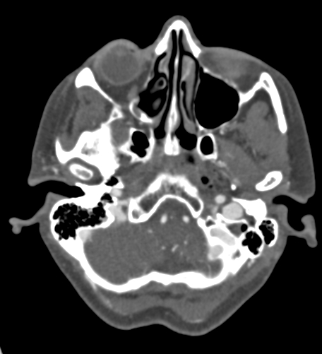 Basilar tip aneurysm with coiling (Radiopaedia 53912-60086 A 26).jpg