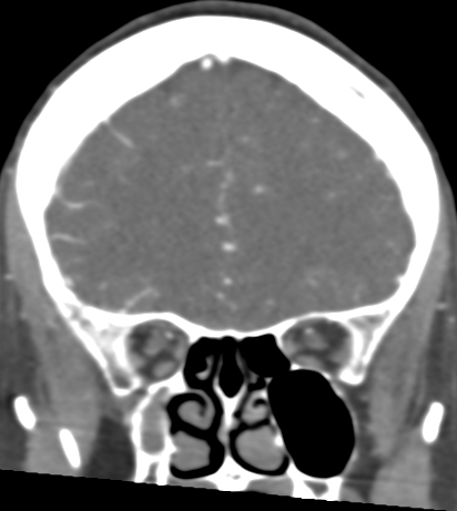 Basilar tip aneurysm with coiling (Radiopaedia 53912-60086 B 38).jpg