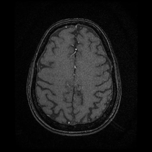 Basilar top and left middle cerebral artery aneurysm (Radiopaedia 61965-70031 Axial MRA 128).jpg