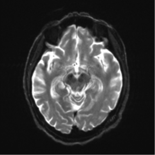 Behavioral variant frontotemporal dementia and late onset schizophrenia (Radiopaedia 52197-58083 Axial DTI Trace W 11).png