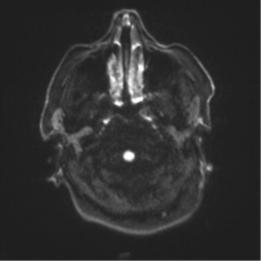 File:Behavioral variant frontotemporal dementia and late onset schizophrenia (Radiopaedia 52197-58083 Axial DTI Trace W 28).png