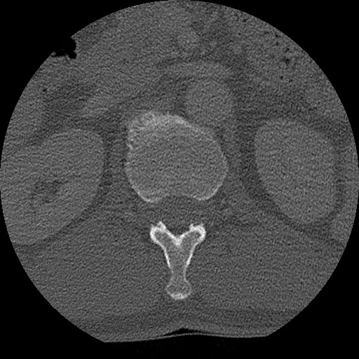 Benign post-traumatic pseudopneumoperitoneum (Radiopaedia 71199-81495 Axial bone window 186).jpg