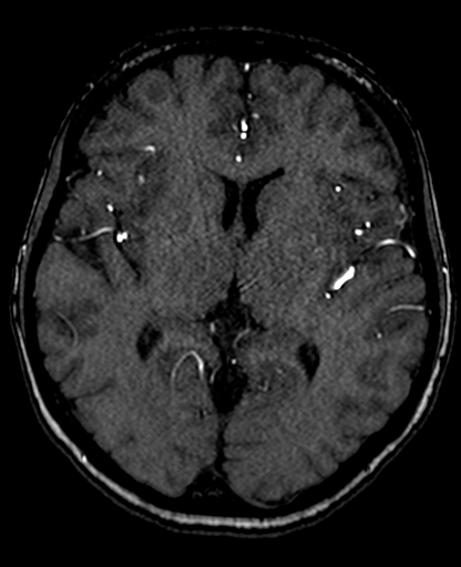 Berry aneurysm of the terminal internal carotid artery (Radiopaedia 88286-104918 Axial TOF 129).jpg