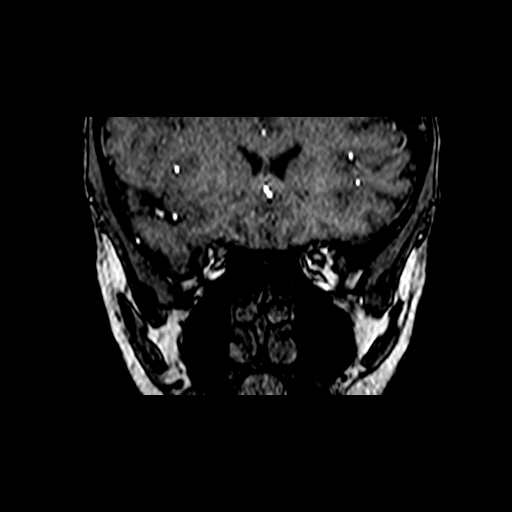 File:Berry aneurysm of the terminal internal carotid artery (Radiopaedia 88286-104918 Coronal TOF 18).jpg