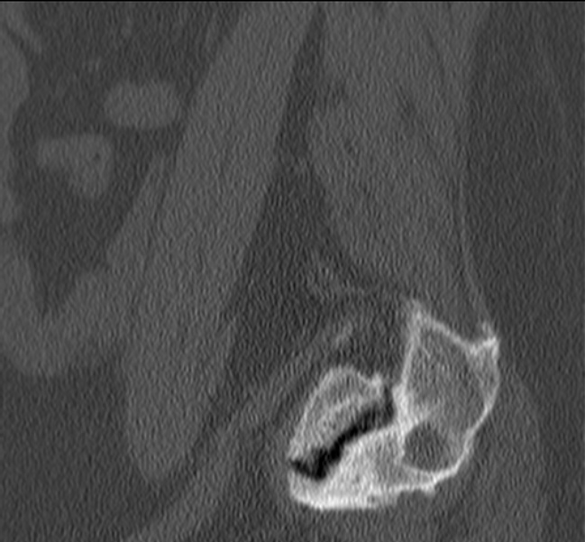 Bertolotti syndrome (Radiopaedia 24864-25128 Sagittal bone window 7).jpg