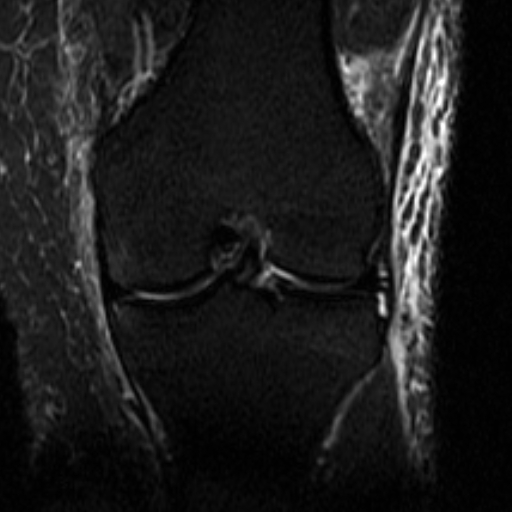 File:Biceps femoris distal tendon avulsion (Radiopaedia 15109-14987 Coronal STIR 2).jpg