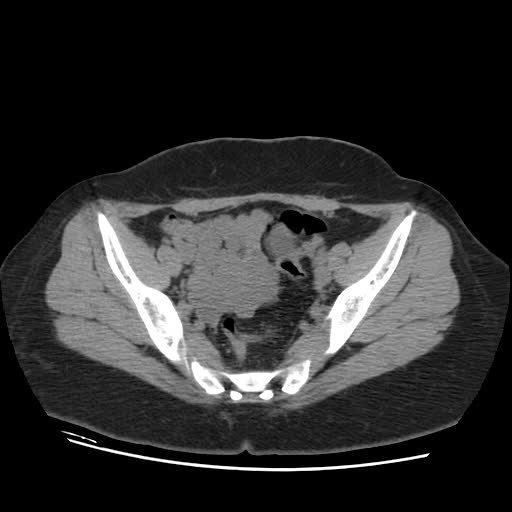 File:Bicornuate uterus (MRI) (Radiopaedia 49206-54296 Axial 11).jpg