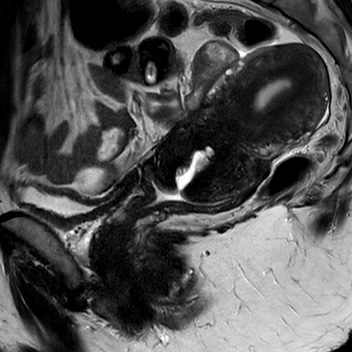 File:Bicornuate uterus (Radiopaedia 61974-70046 Sagittal T2 9).jpg