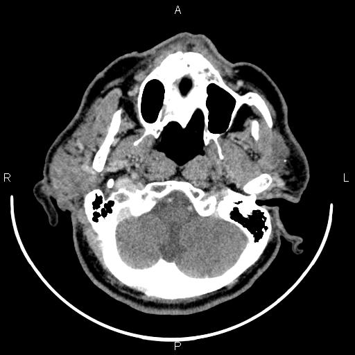 Bilateral Warthin tumors (Radiopaedia 84034-99263 Axial With contrast 13).jpg