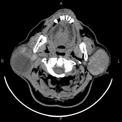 Bilateral Warthin tumors (Radiopaedia 84034-99263 Axial non-contrast 19).jpg