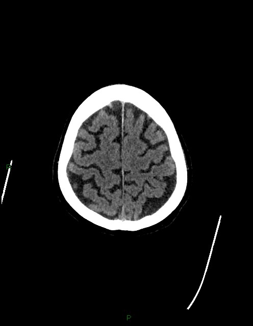 Bilateral acute middle cerebral artery territory infarcts (Radiopaedia 77319-89401 Axial non-contrast 76).jpg