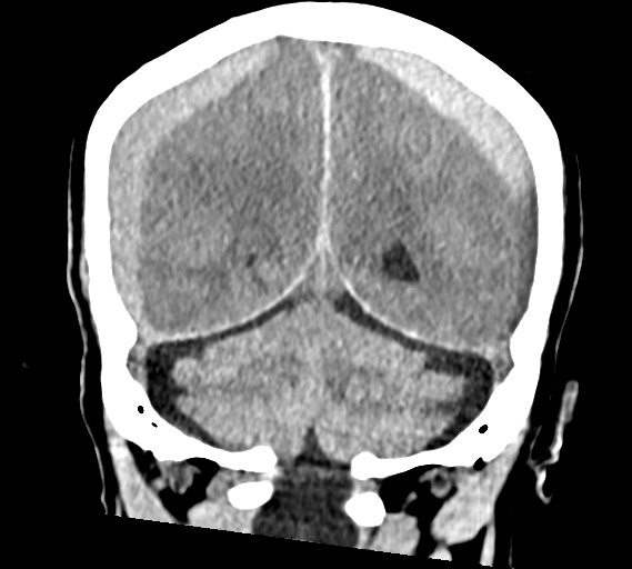 File:Bilateral acute on chronic subdural hematomas (Radiopaedia 78466-91146 Coronal non-contrast 49).jpg