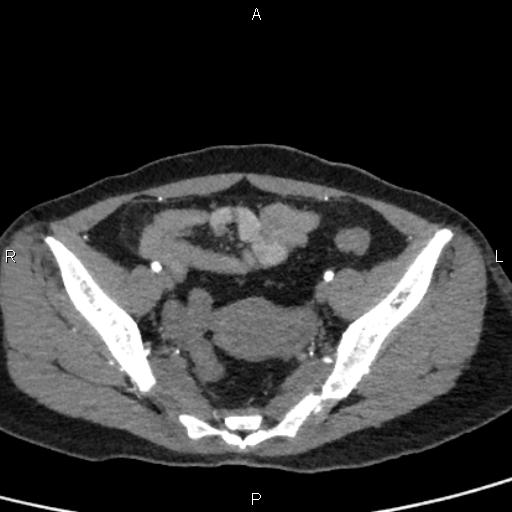 Bilateral adrenal gland hyperenhancement in pancreatitis (Radiopaedia 86642-102753 B 107).jpg