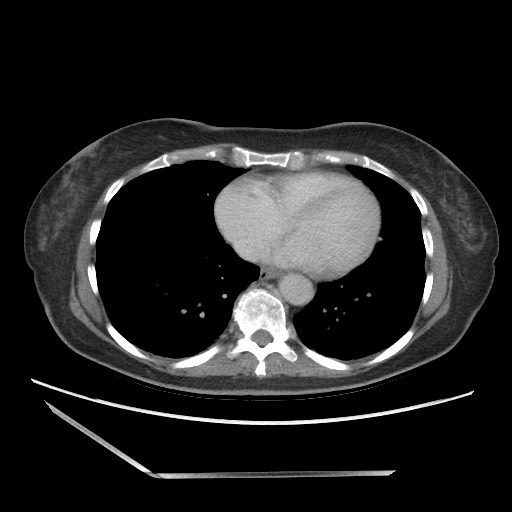 Bilateral adrenal granulocytic sarcomas (chloromas) (Radiopaedia 78375-91007 A 4).jpg