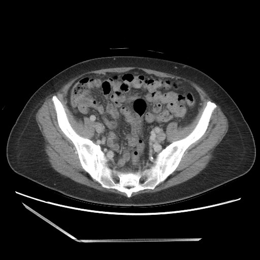 Bilateral adrenal granulocytic sarcomas (chloromas) (Radiopaedia 78375-91007 A 91).jpg
