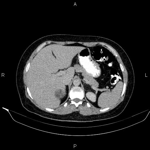 Bilateral adrenal myelolipoma (Radiopaedia 63058-71535 Axial C+ delayed 19).jpg