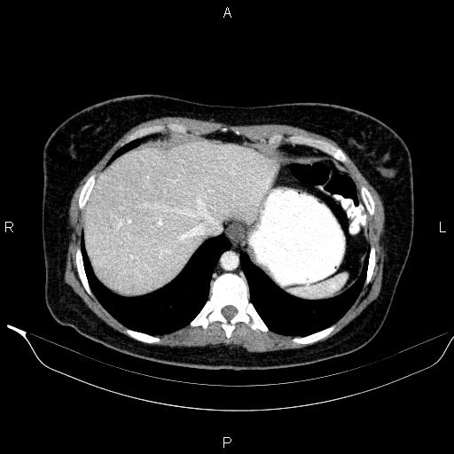 File:Bilateral adrenal myelolipoma (Radiopaedia 63058-71535 B 21).jpg