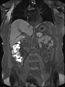 Bilateral adrenal myelolipoma (Radiopaedia 63058-71537 Coronal T1 fat sat 57).jpg