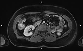 Bilateral adrenal myelolipoma (Radiopaedia 63058-71537 G 56).jpg