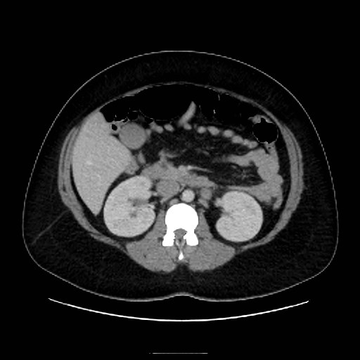 Bilateral adrenal thrombosis (Radiopaedia 58182-65256 A 30).jpg