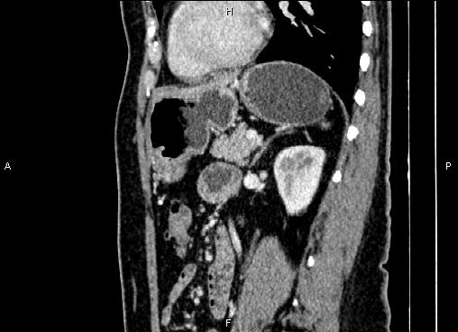 Bilateral benign adrenal adenomas (Radiopaedia 86912-103124 E 64).jpg