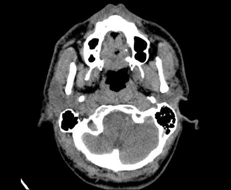 Bilateral carotid body tumors (Radiopaedia 61841-69870 Axial non-contrast 13).jpg