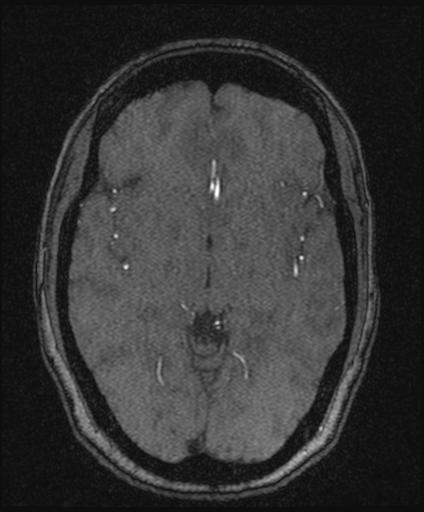 Bilateral carotid body tumors and right glomus jugulare tumor (Radiopaedia 20024-20060 Axial MRA 89).jpg