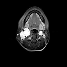 File:Bilateral carotid body tumors and right jugular paraganglioma (Radiopaedia 20024-20060 Axial 93).jpg