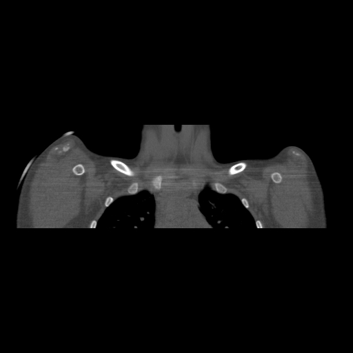 Bilateral chronic posterior shoulder dislocation (Radiopaedia 39213-41452 Coronal bone window 12).jpg