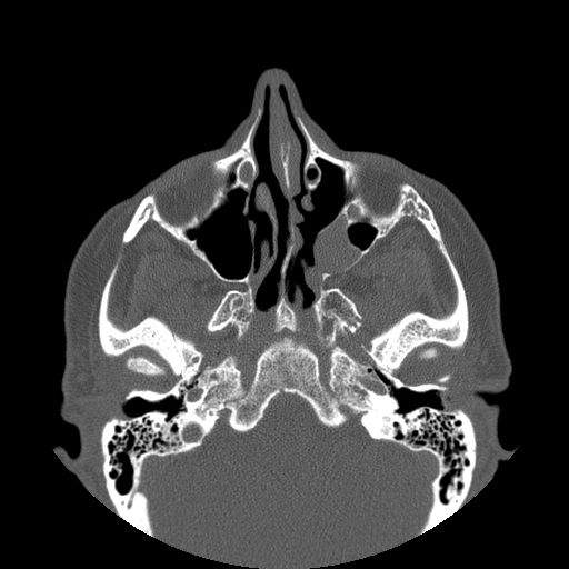 File:Bilateral ectopic infraorbital nerves (Radiopaedia 49006-54084 Axial 4).jpg