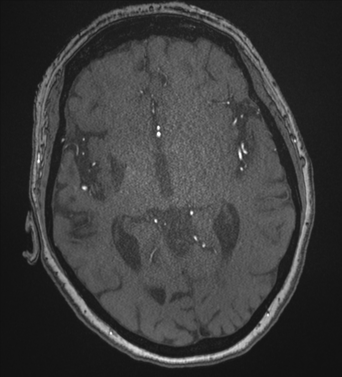 Bilateral fetal posterior communicating arteries (Radiopaedia 41286-44102 Axial MRA 104).png